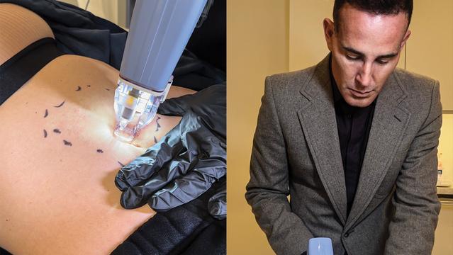 Paul Jarrod Frank treats GLP-1-related sagging with a technique known as Ellacor fractional micro- coring.